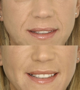 Melbourne-dermal-fillers-before-after-photos-nasolabial-folds